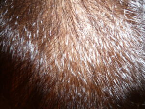 植毛手術後の管理人の頭頂部